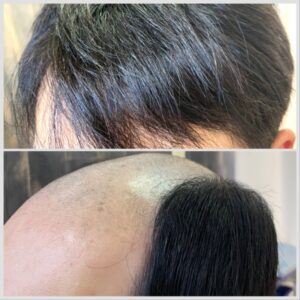 ハゲ対策にお悩みの方へ｜自然な仕上がりの増毛・オーダーかつらなら【ヘアピット】